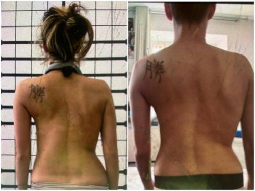 Регина тодоренко поделилась результатами своей борьбы со сколиозом. 04