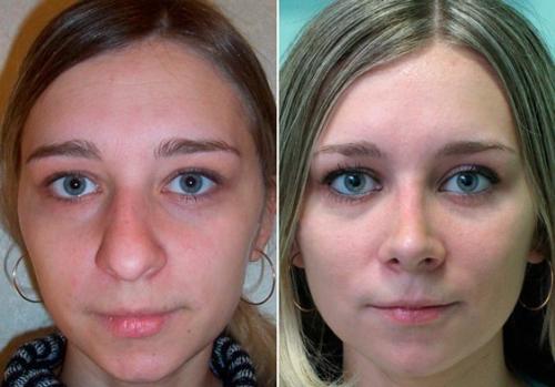 Я исправила горбинку на своем носе за 2 месяца, без операции.  