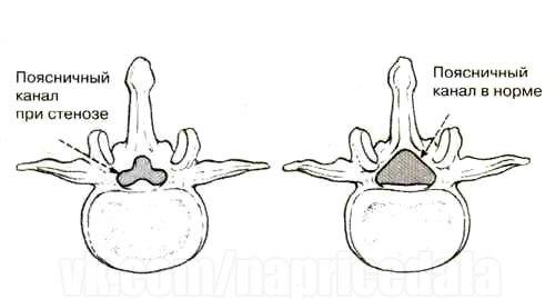 Остеохондроз: Жалеть или закачивать спину? 02