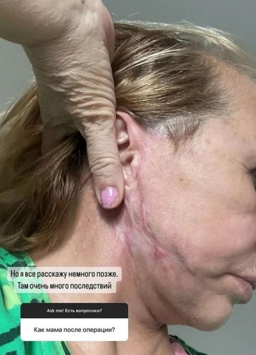 Маме виктории бони изуродовал лицо пластический хирург. 01 Маме виктории бони изуродовал лицо пластический хирург. 01