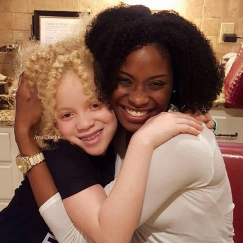 Авa Кларк - афроамериканка - альбинос. 03