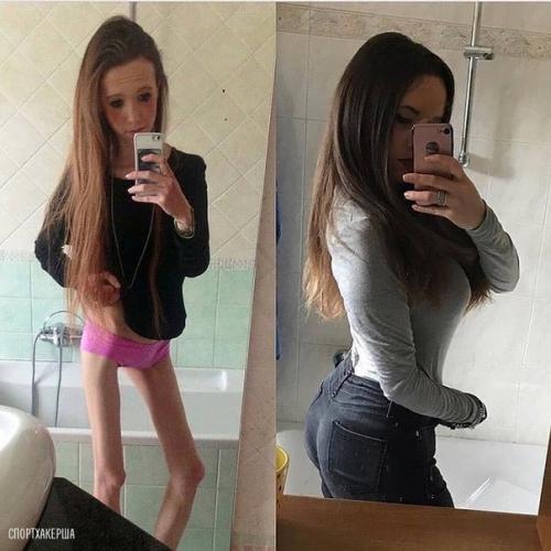 Я думаю, анорексия - это такое же страшное заболевание как и ожирение.