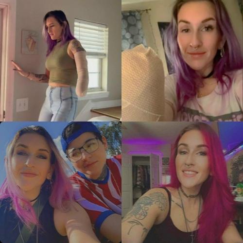 Девушке ампутировали руку после неосторожного использование фена. 

