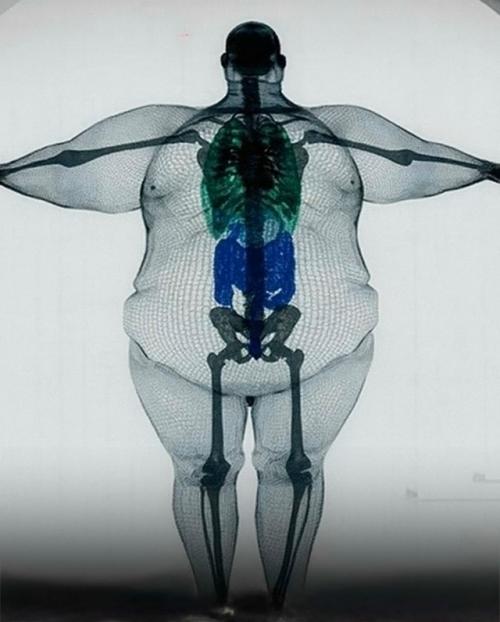 Скелет при ожирении почти не меняется - но нагрузка на него растёт в разы. 01