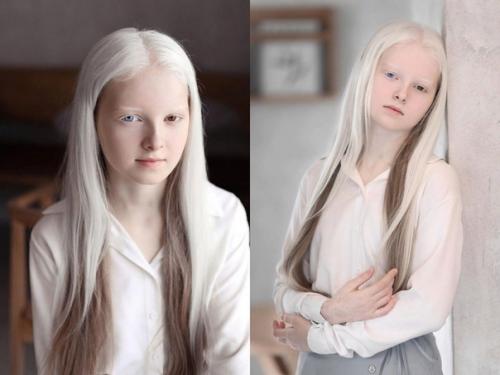 Девoчка - альбиноc из Чeчни c нeобычной внешноcтью. 02