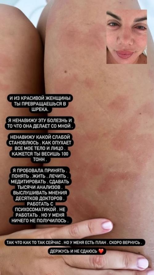 Анна седокова показала, как выглядит во время очередного приступа крапивницы. 01