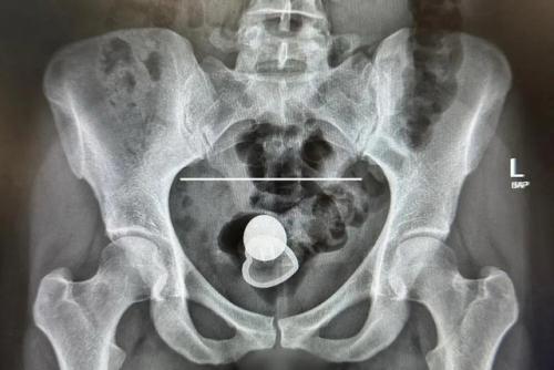 Алисия Дэвис провела два дня в больнице из-за застрявшего в прямой кишке предмета. 01