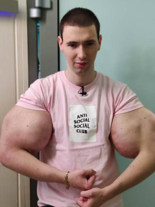 Блогеру Кириллу Терешину, известному как Руки - Базуки, грозит ампутация. 02