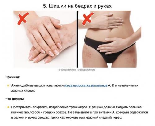 8 сигналов тела, которые помогают понять, каких витаминов не хватает вашему организму. 04