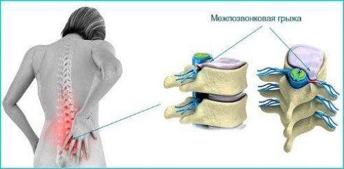 Поясничная грыжа народными способами лечится.

