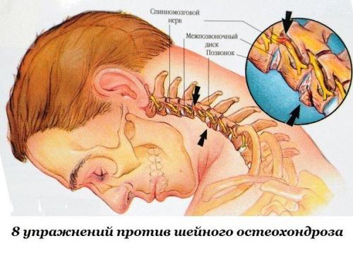 Восемь упражнений против шейного остеохондроза.

