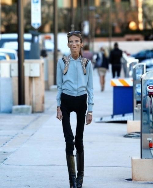 Официально самой худой женщиной в мире признавалась Валерия Левитина, россиянка, которая страдала от анорексии. 01