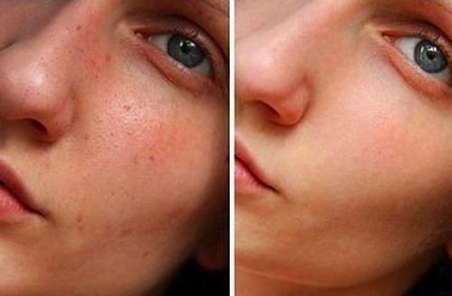 Глубокая чистка лица за 1 процедуру.

