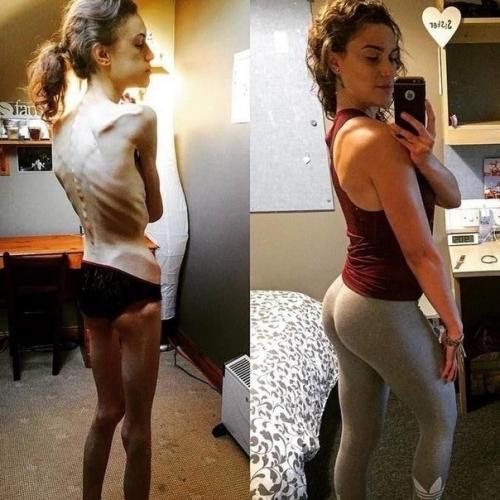 Я восхищаюсь людьми, которые смогли побороть анорексию. 01