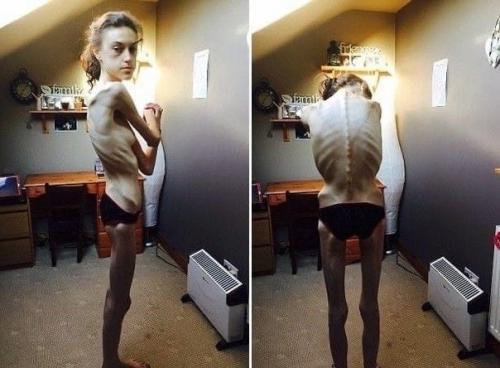 Я восхищаюсь людьми, которые смогли побороть анорексию. 03