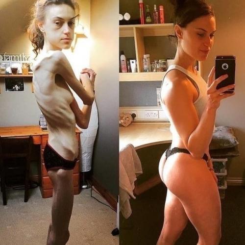 Я восхищаюсь людьми, которые смогли побороть анорексию. 02