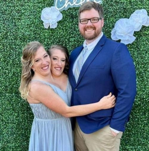 Сиамские сестры - близнецы хенсел ждут ребенка. 02