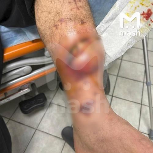 Эдварду билу может понадобиться ампутация ноги - пранкера срочно доставили в больницу из спецприемника. 01