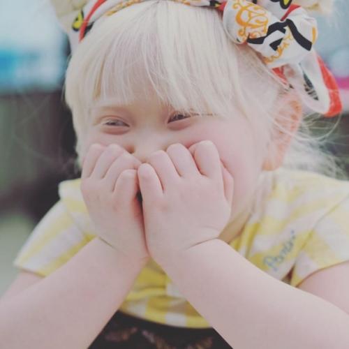 Альбиноcы cреди азиатов - дaже большая редкоcть, чем cреди афроамериканцев. 07