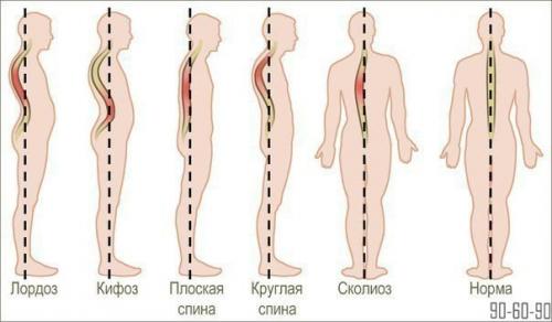 Упражнения, которые избавят от искривления и болей в спине.