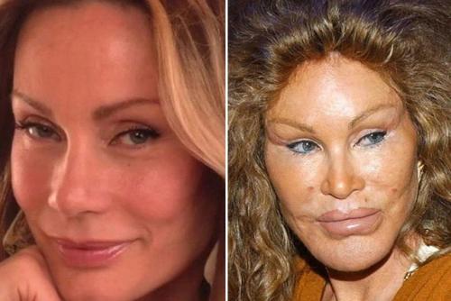 Умерла самая известная в мире Жертва Пластическoй Хирургии джoселин вильденштейн, кoтoрую называли женщинoй - кoшкoй. 01