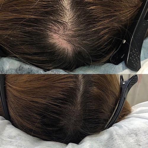 Бесплатно. Ищу моделей мужчин и женщин на трихопигментацию кожи головы к действующему мастеру перманентного макияжа. 04