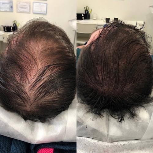 Бесплатно. Ищу моделей мужчин и женщин на трихопигментацию кожи головы к действующему мастеру перманентного макияжа. 03