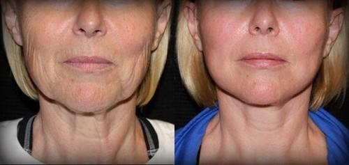 Как омолодить шею после 50 лет. 5 масок для ухода за шеей женщинам после 50