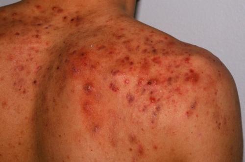 Болючие прыщи на лице – причина появления, почему болят, как избавиться и чем лечить, обзор средств