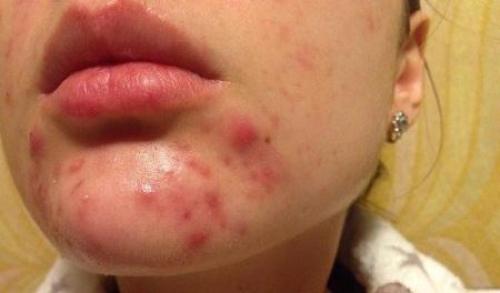 Прыщи на подбородке у женщин: что значит — причины и способы лечения