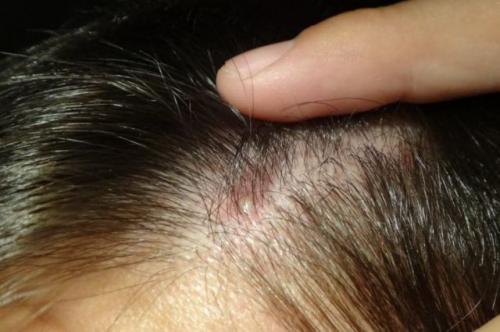 Болючие прыщи на лице – причина появления, почему болят, как избавиться и чем лечить, обзор средств