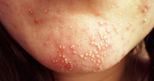 Прыщи на подбородке у женщин: что значит — причины и способы лечения