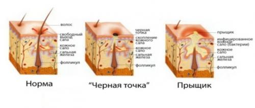 О чем говорят прыщи. Локализация высыпаний 07 О чем говорят прыщи. Локализация высыпаний 07