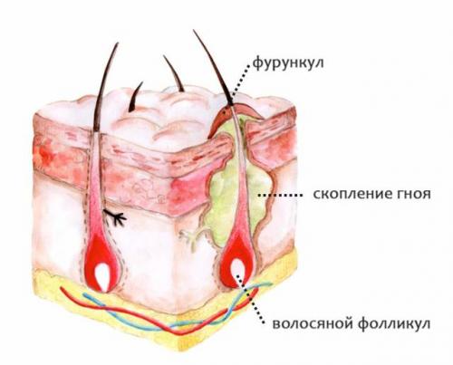 Болючие прыщи на лице – причина появления, почему болят, как избавиться и чем лечить, обзор средств