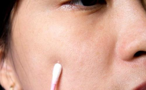 О чем говорят прыщи. Локализация высыпаний 11 О чем говорят прыщи. Локализация высыпаний 11