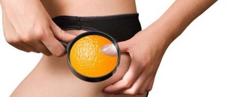 Состав антицеллюлитного крема с разогревающим эффектом. Эффективная борьба с целлюлитом при помощи косметических средств