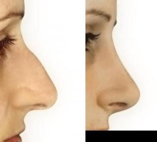 Вздернутый нос у женщин. Форма носа и характер человека 04 Вздернутый нос у женщин. Форма носа и характер человека 04