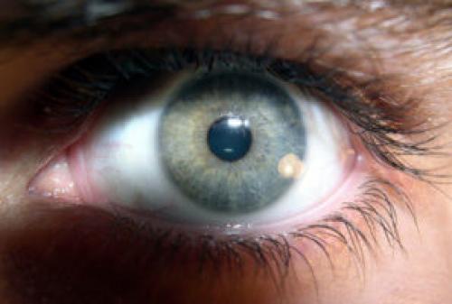 Ослабление глазной мышцы. Пару слов о патологиях глазных мышц