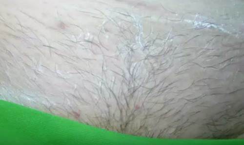 Как удалить волосы в интимной зоне навсегда. Ваксинг, депиляция шугаринг глубокое бикини