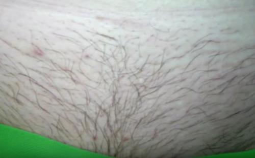 Как удалить волосы в интимной зоне навсегда. Ваксинг, депиляция шугаринг глубокое бикини