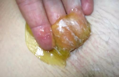 Как удалить волосы в интимной зоне навсегда. Ваксинг, депиляция шугаринг глубокое бикини