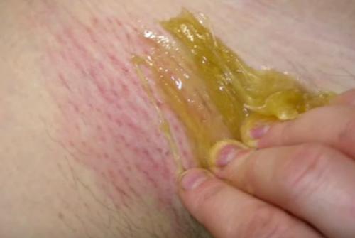 Как удалить волосы в интимной зоне навсегда. Ваксинг, депиляция шугаринг глубокое бикини