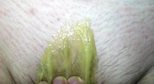 Как удалить волосы в интимной зоне навсегда. Ваксинг, депиляция шугаринг глубокое бикини