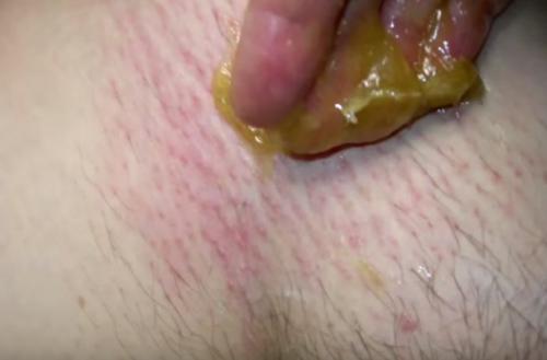 Как удалить волосы в интимной зоне навсегда. Ваксинг, депиляция шугаринг глубокое бикини