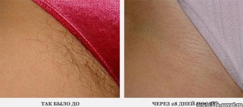 Как убрать волосы в зоне бикине навсегда в домашних условиях.