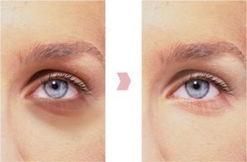 Как убрать синяки под глазами в домашних условиях. Народное лечение