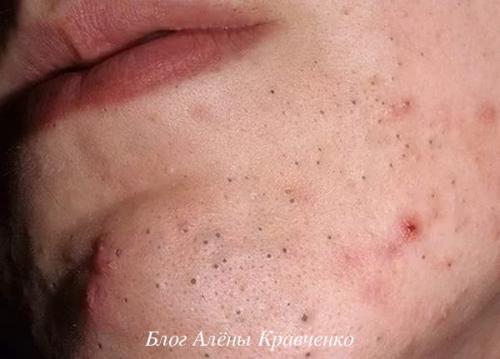 Маска от черных точек и угрей в домашних условиях. Особенности лечения прыщей в домашних условиях 09 Маска от черных точек и угрей в домашних условиях. Особенности лечения прыщей в домашних условиях 09