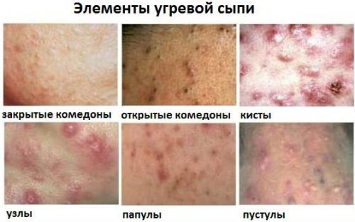 О чем говорят прыщики на попе. Причины образования прыщиков на попе