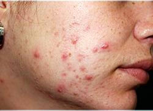 О чем говорят прыщики на щеках. О чем говорят прыщи на щеках — причины появления и методы их лечения