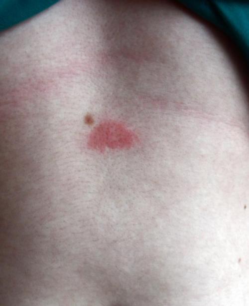 После прыща образовалась родинка. Прыщ на родинке
